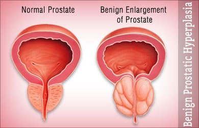 Benign Prostatic Hypertrophy Arman Behboud Aria Experts Focus On You